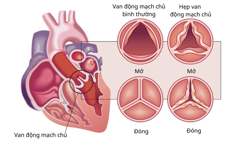 Bị hẹp van động mạch chủ nguy hiểm không? Có phải phẫu thuật?